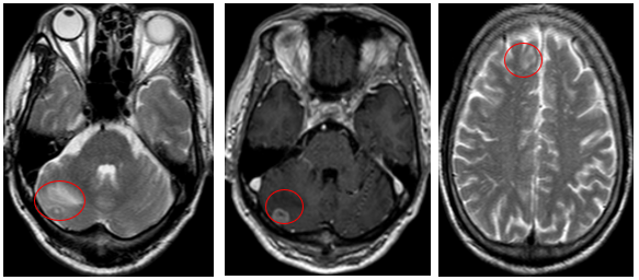 Ca lâm sàng: Điều trị đích bệnh nhân ung thư phổi không tế bào nhỏ giai đoạn muộn di căn nhiều cơ quan, tại Trung tâm Y học hạt nhân và Ung bướu – Bệnh viện Bạch Mai