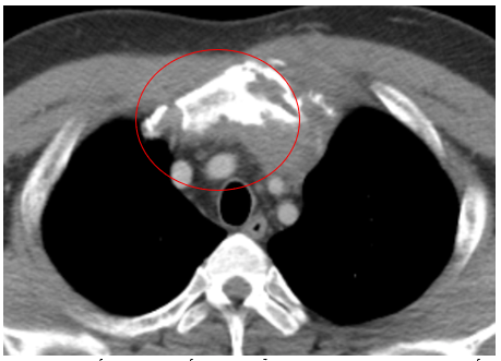 Ca lâm sàng  Điều trị bệnh nhân U lympho Hodgkin típ hỗn hợp tế bào tại Trung tâm Y học hạt nhân và Ung bướu - Bệnh viện Bạch Mai