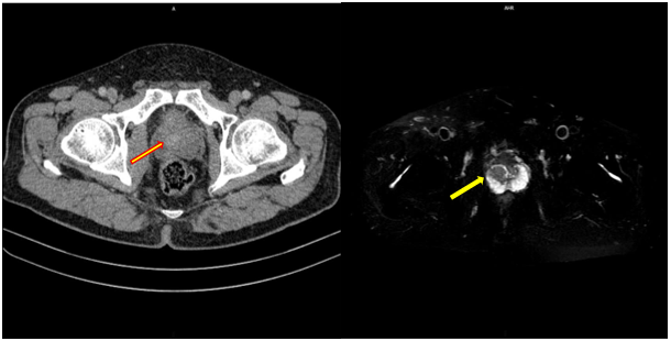 CASE LÂM SÀNG: Điều trị bệnh nhân mắc đồng thời hai loại ung thư: Ung thư phổi và ung thư tuyến tiền liệt