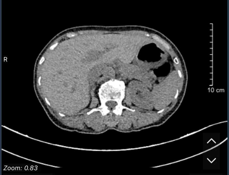 Case lâm sàng: Chẩn đoàn và điều trị ung thư tuyến giáp thể nhú di căn phổi tại Trung tâm Y học hạt nhân và Ung bướu, Bệnh viện Bạch Mai.