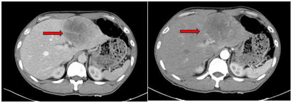 CASE LÂM SÀNG:  ĐIỀU TRỊ BỆNH NHÂN SARCOMA CƠ TRƠN HIẾM GẶP Ở GAN  TẠI TRUNG TÂM Y HỌC HẠT NHÂN VÀ UNG BƯỚU, BỆNH VIỆN BẠCH MAI