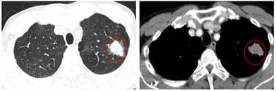Ca lâm lâm sàng  Bệnh nhân mắc hai ung thư nguyên phát: Ung thư phổi không tế bào nhỏ và Ung thư trực tràng