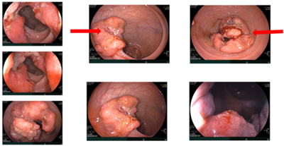 Ca lâm sàng: Điều trị tân bổ trợ ung thư trực tràng giúp giảm giai đoạn và phẫu thuật triệt căn tại Trung tâm Y học hạt nhân và Ung bướu - Bệnh viện Bạch Mai