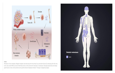 ĐAU TRONG UNG THƯ DI CĂN XƯƠNG