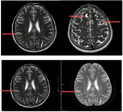 Điều trị ung thư phổi di căn não tại Trung tâm Y học hạt nhân và Ung bướu - Bệnh viện Bạch Mai
