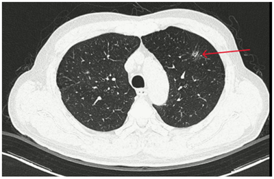 Case lâm sàng: Ứng dụng trí tuệ nhân tạo (Artificial intelligence – AI) trong chẩn đoán và điều trị sớm Ung thư phổi tại Trung tâm Y học hạt nhân và Ung bướu, Bệnh viện Bạch Mai