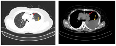 Ca lâm sàng:Hiệu quả điều trị đích bằng Osimertinib ở bệnh nhân UT biểu mô tuyến của phổi giai đoạn IV có đột biến gen EGFR L858R (Exon 21) tại Trung tâm YHHN&UB-Bệnh viện Bạch Mai