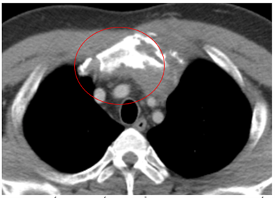 Ca lâm sàng  Điều trị bệnh nhân U lympho Hodgkin típ hỗn hợp tế bào tại Trung tâm Y học hạt nhân và Ung bướu - Bệnh viện Bạch Mai