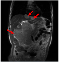 CASE LÂM SÀNG: U Thần kinh nội tiết tế bào lớn biểu hiện tại gan