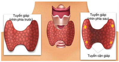 MỘT SỐ BIẾN CHỨNG SAU PHẪU THUẬT CẮT TUYẾN GIÁP TRONG ĐIỀU TRỊ UNG THƯ TUYẾN GIÁP