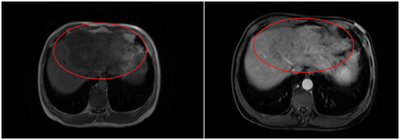 Ca lâm sàng: Hiệu quả điều trị Atezolizumab kết hợp Bevacizumab trong điều trị ung thư biểu mô tế bào gan giai đoạn tiến xa.