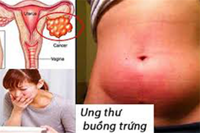 10 triệu chứng phát hiện ung thư buồng trứng sớm không thể bỏ qua cho mọi lứa tuổi