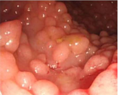 Ca lâm sàng: Chẩn đoán và điều trị u lympho không Hodgkin tế bào T của da (Mycosis fungoides) tại Trung tâm Y học hạt nhân và ung bướu, Bệnh viện Bạch Mai