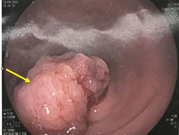 Đánh giá và quản lý polyp đại trực tràng ác tính