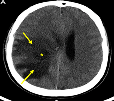 Chẩn đoán và điều trị phù não do khối u nội sọ