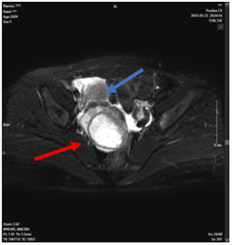 CA LÂM SÀNG: Điều trị ung thư phổi không tế bào nhỏ di căn, giai đoạn muộn  tại Trung tâm Y học hạt nhân và Ung bướu - Bệnh viên Bạch Mai
