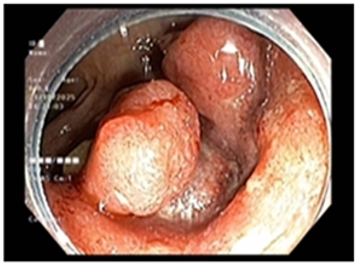 CA LÂM SÀNG: ĐIỀU TRỊ ĐA MÔ THỨC UNG THƯ TRỰC TRÀNG TẠI BỆNH VIỆN BẠCH MAI
