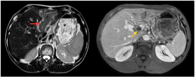 Case lâm sàng:  Điều trị miễn dịch kết hợp thuốc kháng tăng sinh mạch cho bệnh nhân ung thư biểu mô tế bào gan tại trung tâm y học hạt nhân và ung bướu - BV Bạch Mai