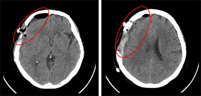 Ca lâm sàng:  Ung thư tuyến giáp thể nang di căn màng não  tại Trung tâm Y học hạt nhân và Ung bướu Bệnh viện Bạch Mai