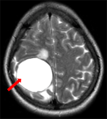 CASE LÂM SÀNG  HIỆU QUẢ CỦA OSIMERTINIB TRONG ĐIỀU TRỊ BỆNH NHÂN UNG THƯ PHỔI DI CĂN NÃO TẠI BỆNH VIỆN BẠCH MAI