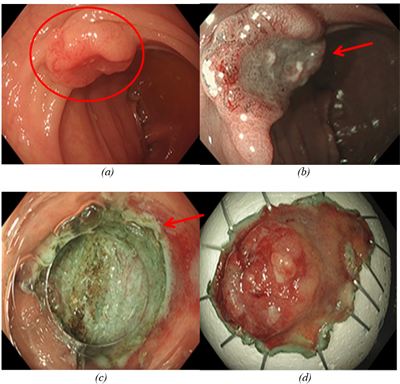 Chẩn đoán và điều trị bệnh nhân mắc đồng thời hai loại ung thư: Ung thư đại tràng và Ung thư dạ dày ở giai đoạn sớm tại Trung tâm Y học hạt nhân và Ung bướu - Bệnh viện Bạch Mai