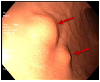 CA LÂM SÀNG:  CHẨN ĐOÁN VÀ ĐIỀU TRỊ U SCHWANNOMA DẠ DÀY TẠI TRUNG TÂM Y HỌC HẠT NHÂN VÀ UNG BƯỚU BỆNH VIỆN BẠCH MAI