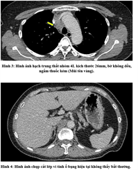 Ca lâm sàng: Kết hợp thuốc miễn dịch Pembrolizumab và hóa chất trong điều trị ung thư phổi giai đoạn tiến triển tại bệnh viện Bạch Mai