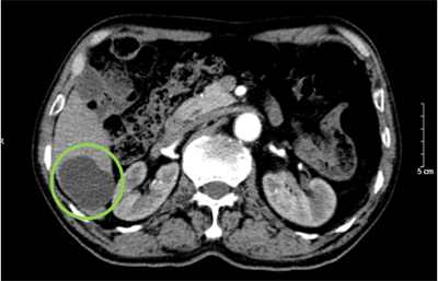 CASE LÂM SÀNG:  ĐIỀU TRỊ UNG THƯ PHỔI TẾ BÀO NHỎ BẰNG LIỆU PHÁP MIỄN DỊCH TẠI TRUNG TÂM YHHN VÀ UNG BƯỚU BỆNH VIỆN BẠCH MAI