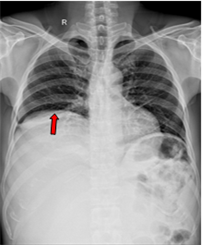 CA LÂM SÀNG: Điều trị khối u lớn liposarcoma sau phúc mạc tại Trung tâm Y học hạt nhân và Ung bướu - Bệnh viện Bạch Mai