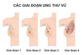 Gia tăng bệnh nhân mắc ung thư vú